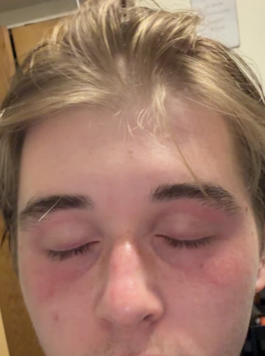 Andrew Hopper — close-up showing a rosacea flare